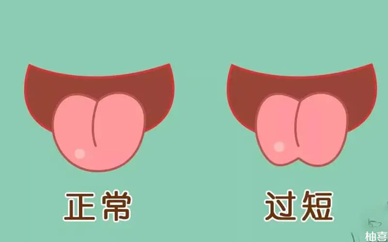 舌系带短怎么看图片