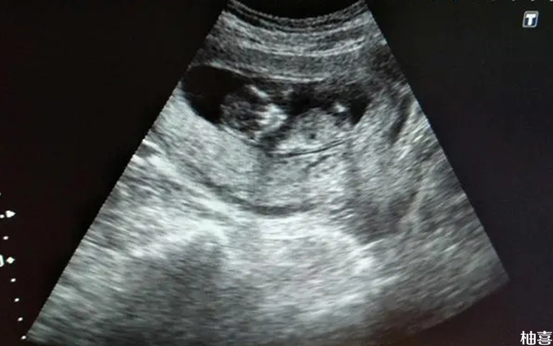 孕12周胎儿真实图图片