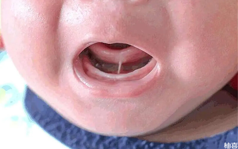 舌系带矫正手术最佳年龄