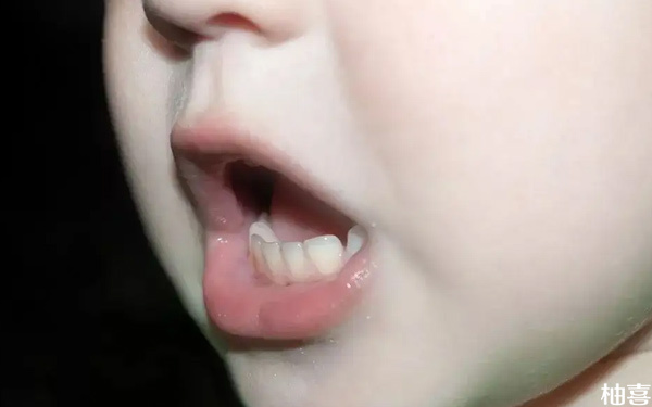 孩子舌系带短不容忽视，影响说话仅为常见危害之一	
