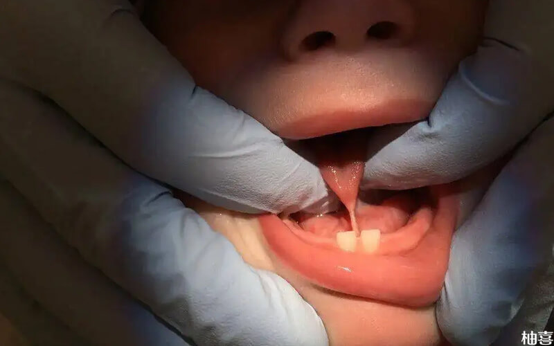 舌系带过短需要手术矫正