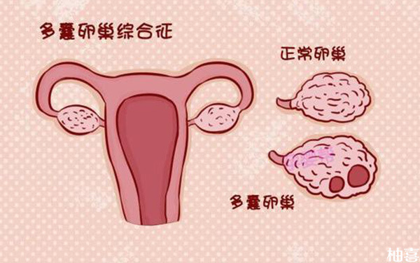 基础卵泡数量有11个，会不会是多囊卵巢综合征?