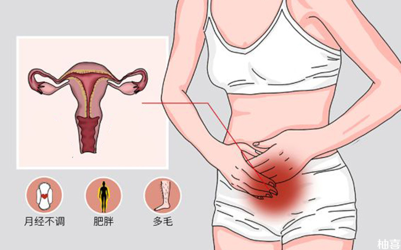 多囊卵巢综合征会导致月经不调
