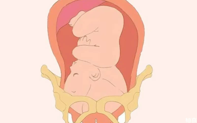 胎儿不入盆对骨盆有影响吗