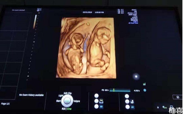 双绒双羊为什么必须要在孕37周用剖腹产结束妊娠？ 怀孕双胎七个半月早产