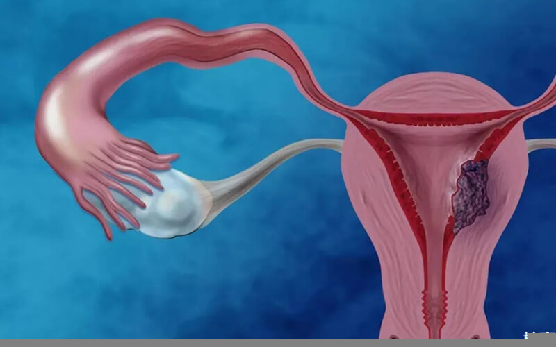 多囊卵巢可以吃黄体酮调节激素平衡
