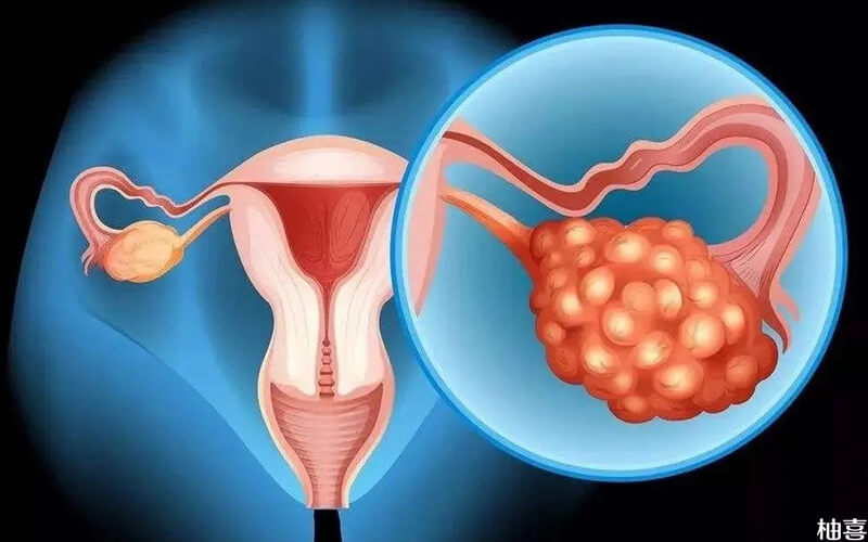 多囊卵巢需在月经期服用优思明