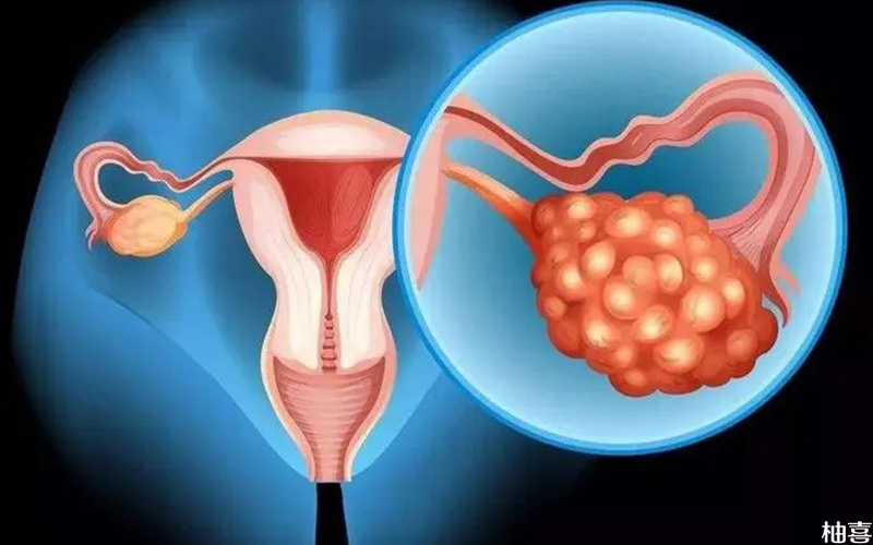 多囊卵巢会对女性的生育功能产生影响