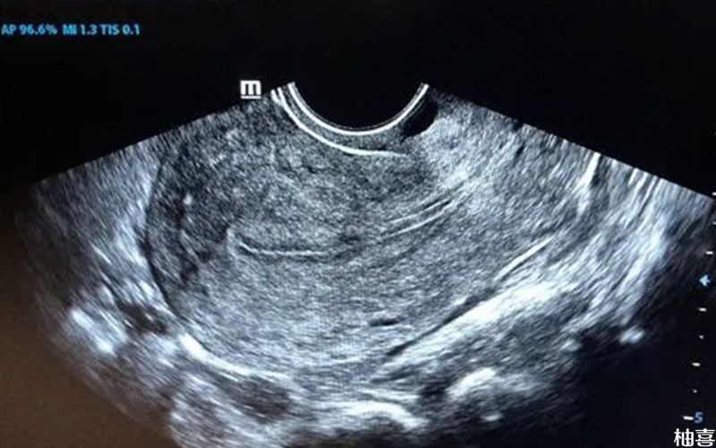三线征属于是B超下子宫内膜的形态