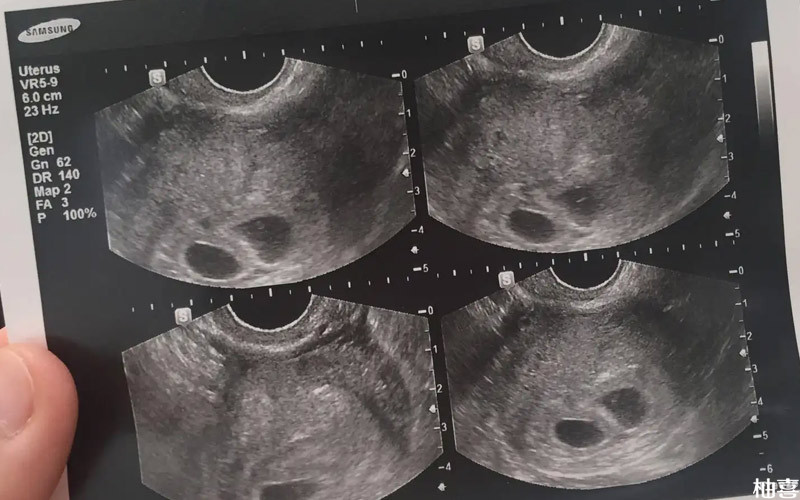 卵黄囊说明没有宫外孕的可能