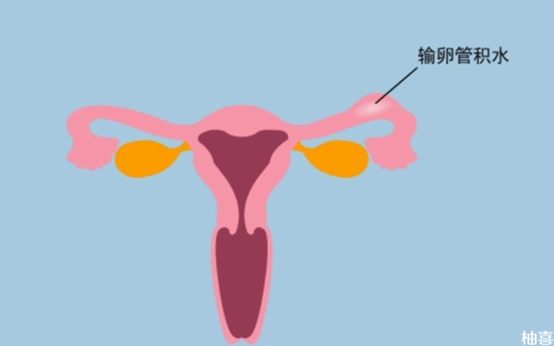 输卵管黏膜发生积水会引起堵塞