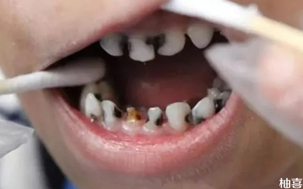 5岁儿童蛀牙烂了个洞到底要不要补?