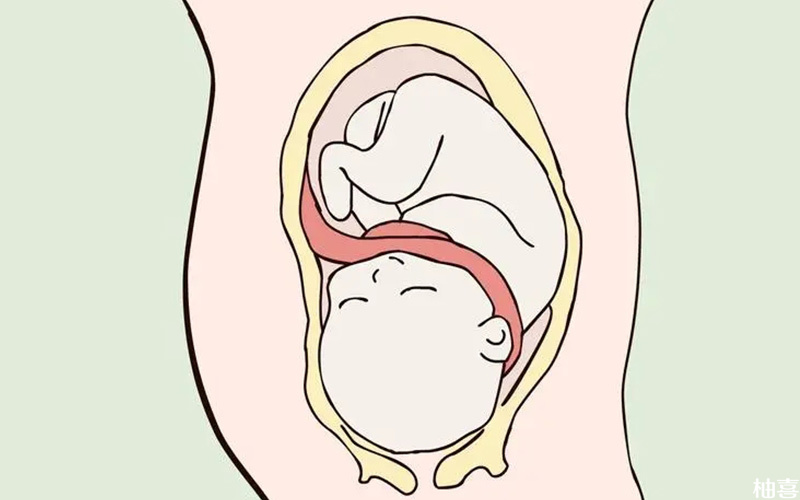 脐带扭转会导致胎停