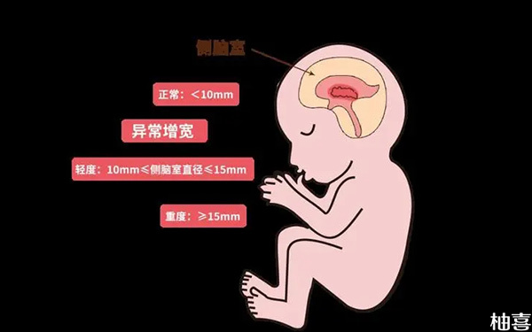 孕35周无创DNA左侧脑室增宽1.1孩子还能要吗?