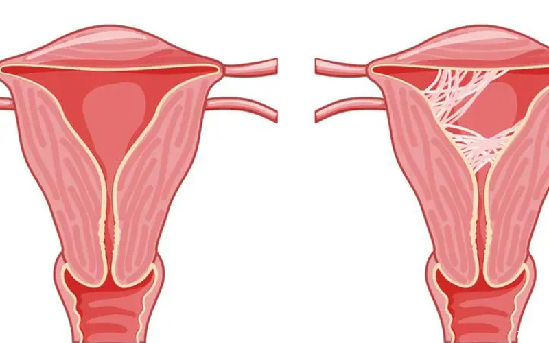 重度宫腔粘连会影响移植成功率