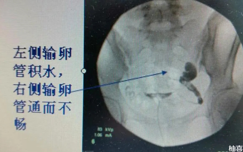 输卵管积水可能会导致移植失败