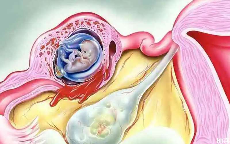移植鲜胚容易出现宫外孕