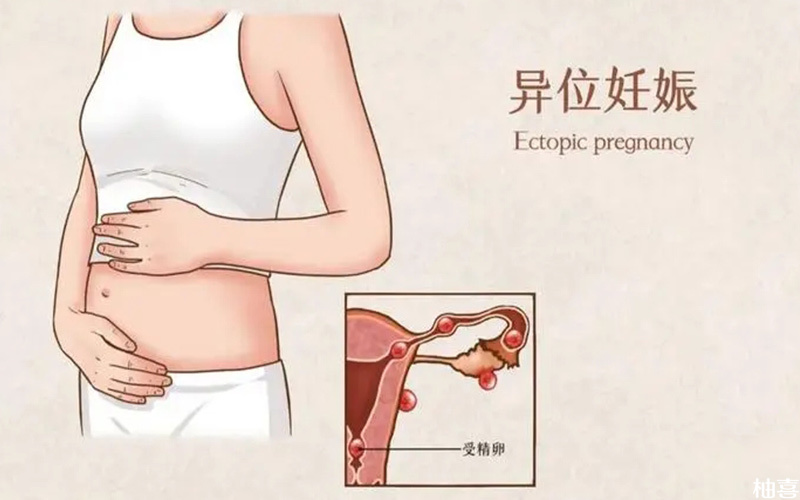 宫外孕属于异位妊娠