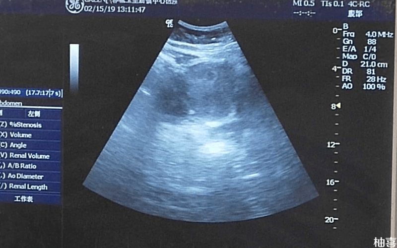 孕囊偏小会导致胎儿出现停育情况
