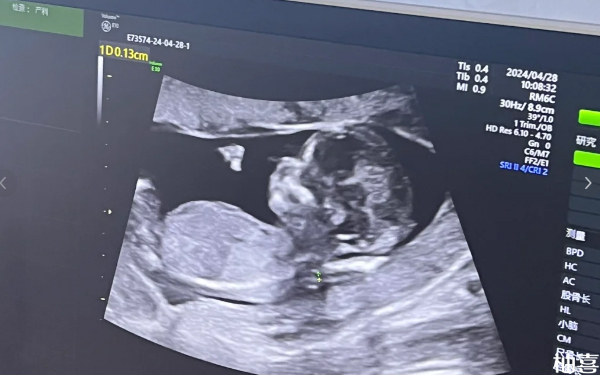 赤峰市妇产医院第2代试管怀双胞胎能保住吗？
