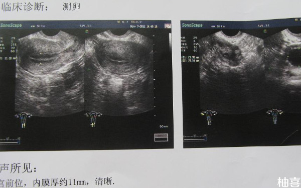 大连妇产医院卵泡监测多少钱一次？