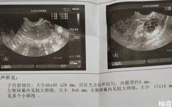 多囊患者在鞍山妇儿医院做试管婴儿费用多少？