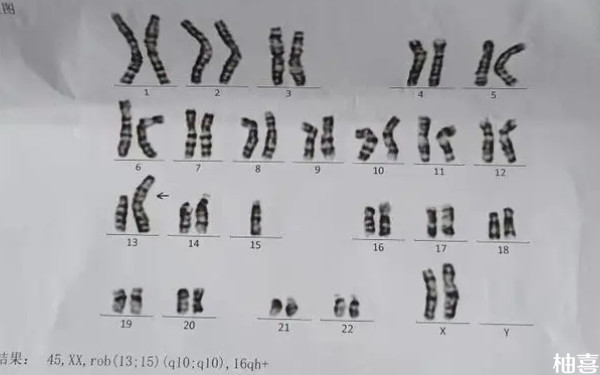 染色体缺失没有说几号染色体正常吗？