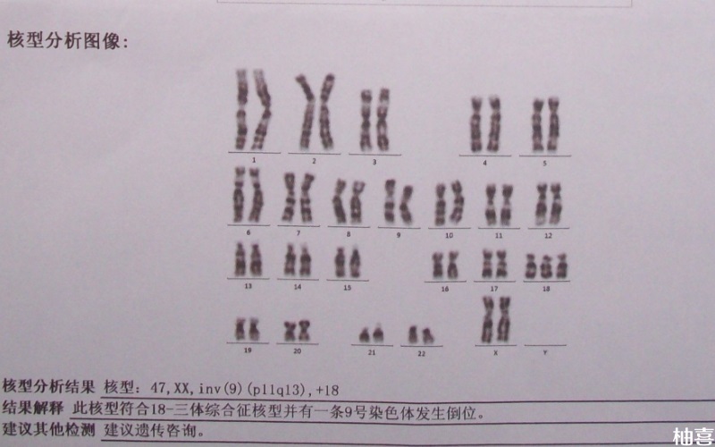 孕期做无创DNA21三体高风险翻盘几率低