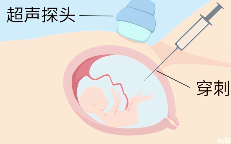 羊膜腔穿刺能检测遗传疾病