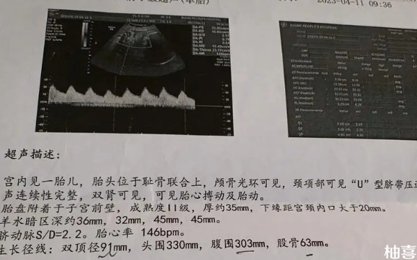 老人说孕晚期脐带绕颈的小孩出生是贵人是真的吗？