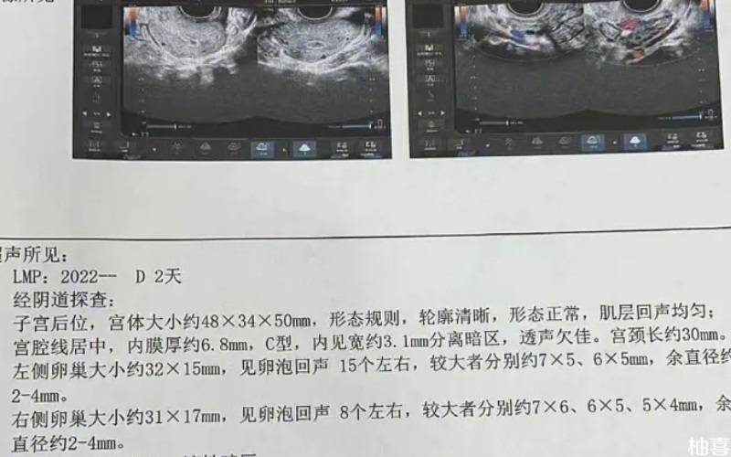 试管促排前看窦卵泡正常