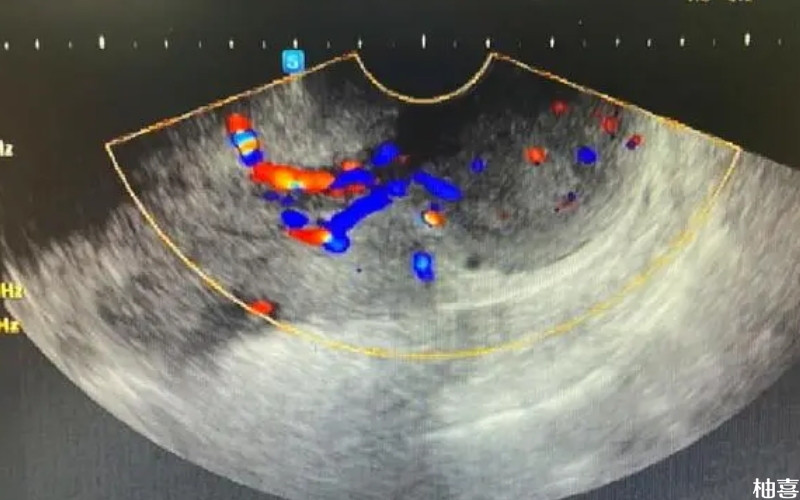 试管取卵后可以查子宫动脉血流