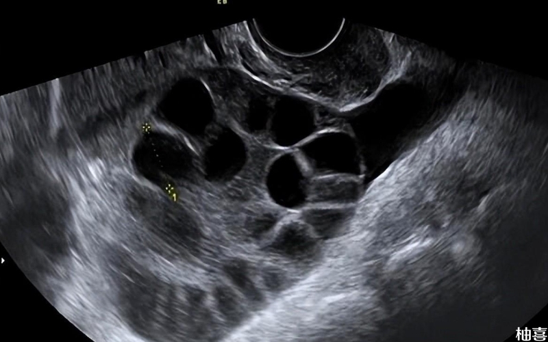 多囊是一种常见生殖内分泌代谢性疾病