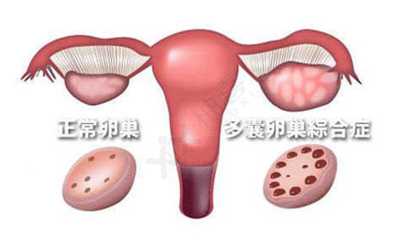 多囊卵巢适合做试管吗