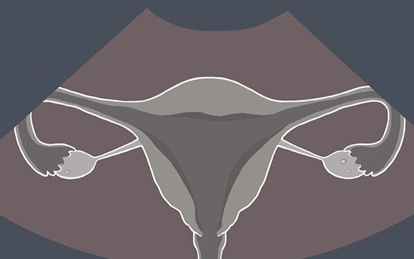 多囊卵巢降低体重5-10%可以使80%以上的患者恢复排卵
