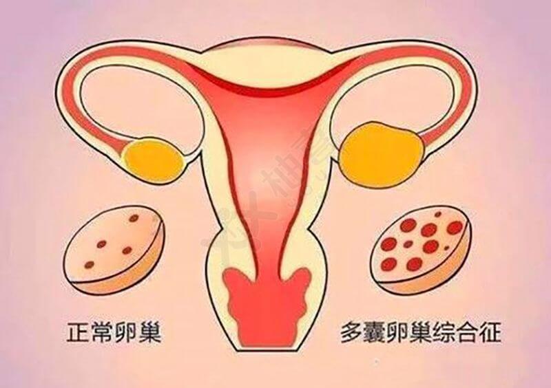 正常卵巢与多囊卵巢综合征的区别