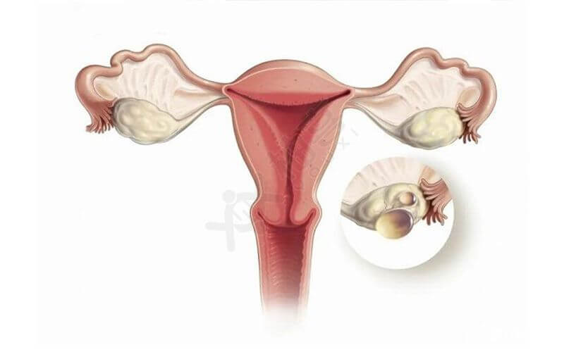 排卵功能紊乱或丧失是多囊卵巢的一大表现