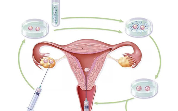 卵巢早衰促排反应不佳,且看短方案如何实现10天7枚