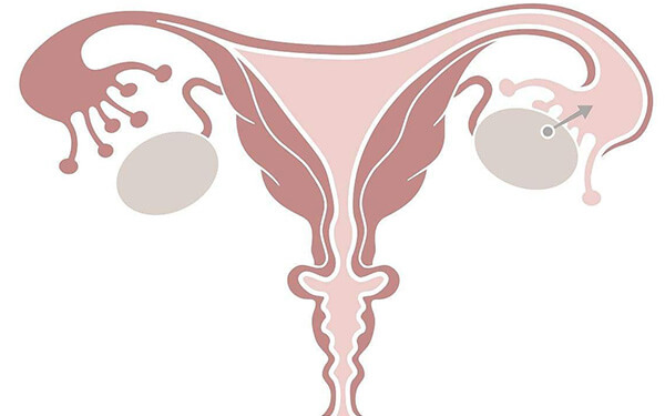 准备做试管婴儿，要如何预防宫腔粘连？
