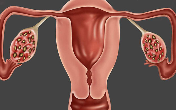 畸胎瘤致不排卵怎么办?掌握3个治疗步骤,"好孕"不会远