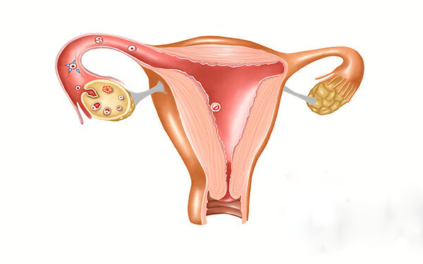 单角合并残角子宫有多严重，会影响女性生育率吗？