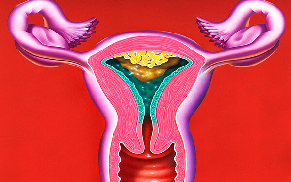 残角子宫有多严重，会影响女性正常怀孕生孩子吗？