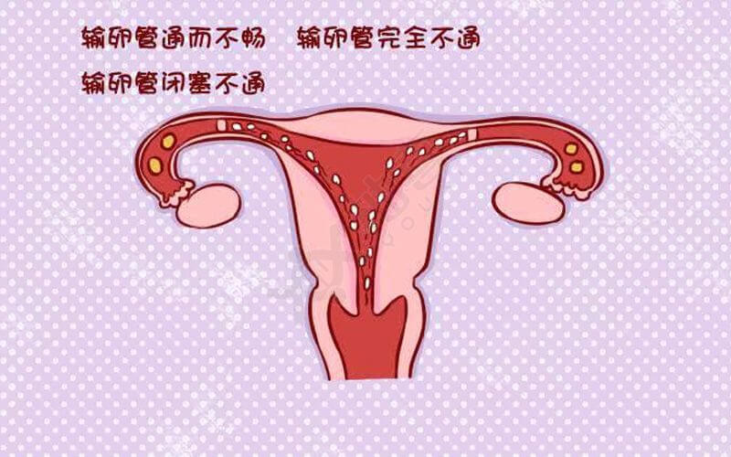 输卵管堵塞检查方法