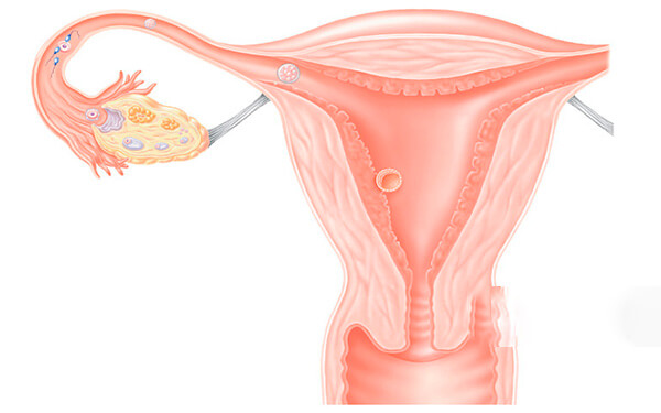 因输卵管积液3cm做切除后想怀孕，请问还能接上吗？
