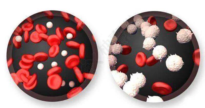 PDGFRB相关的慢性嗜酸性粒细胞白血病