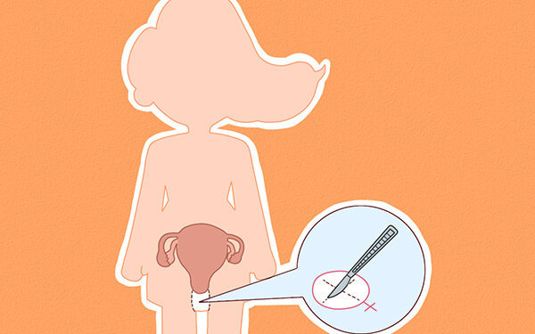 女性先天无阴道,但卵巢正常,3点不得不选腹部取卵的原因