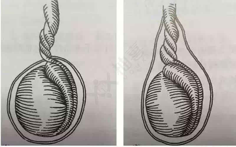 睾丸扭转示意图图片