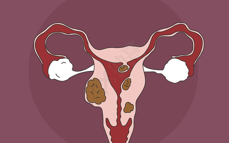 子宫肌瘤吃中药调理可以消除吗