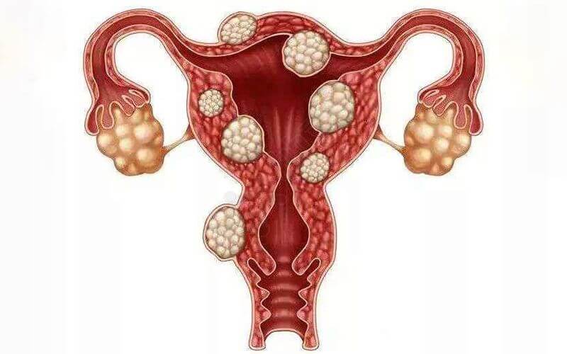 子宫肌瘤的原因有哪些是长期服用雌激素导致的吗
