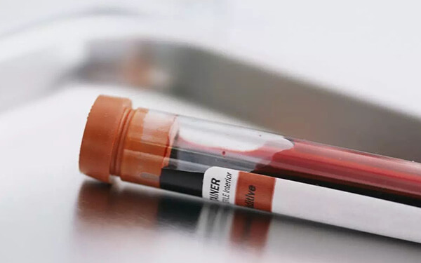 孟买血型怎么鉴定?临床上普遍采用这种方法